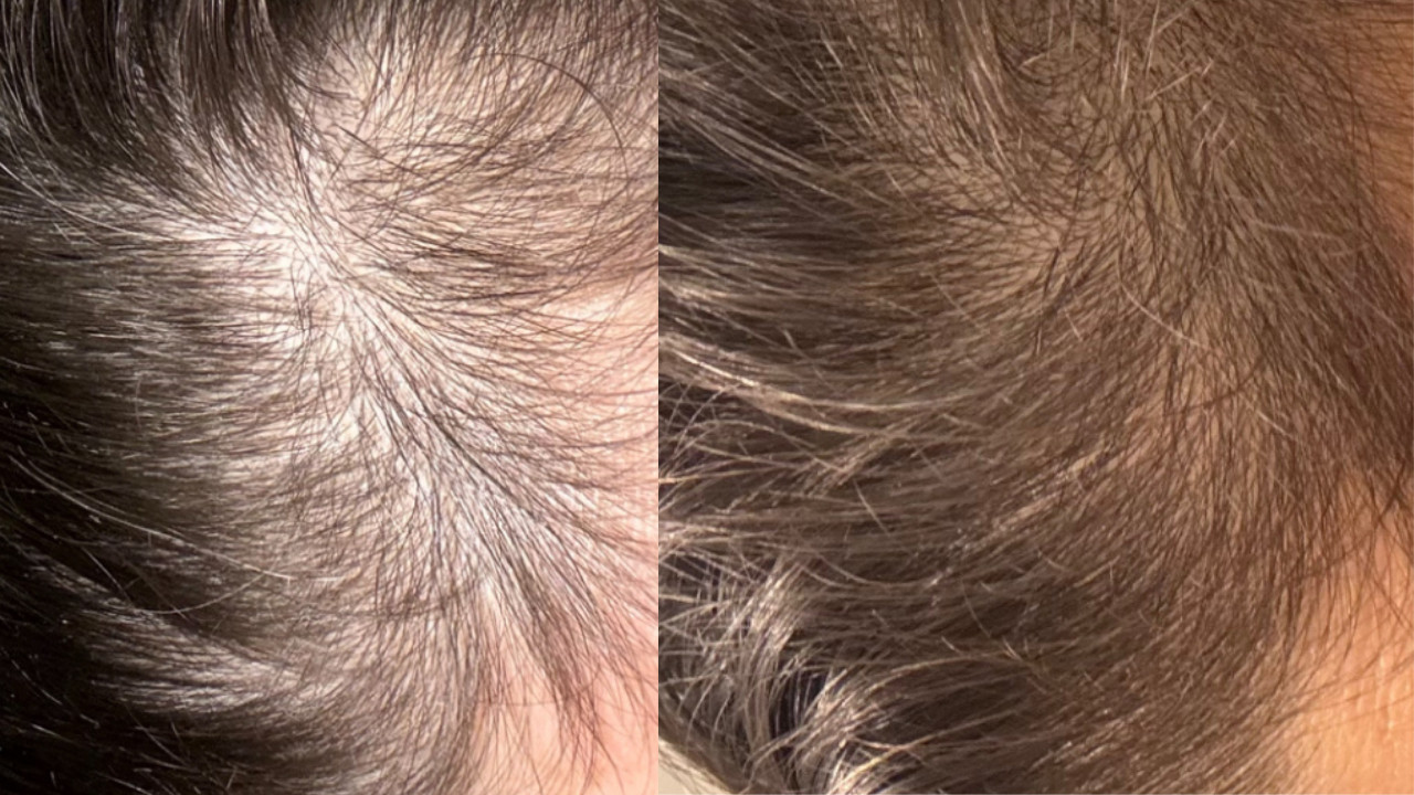 Galéria: Ezzel a kúrával már 8 hét alatt búcsút mondhatsz a hajhullásnak 