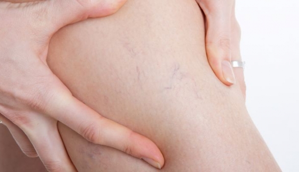 Borítókép: Túl fiatal vagyok ahhoz, hogy seprűvénáim legyenek - vagy mégsem? 