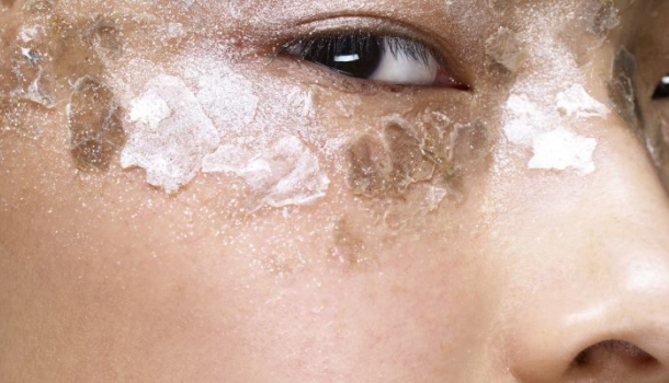 Borítókép: Kikészíti a tél a bőrödet? Van megoldás a túl száraz bőrre!