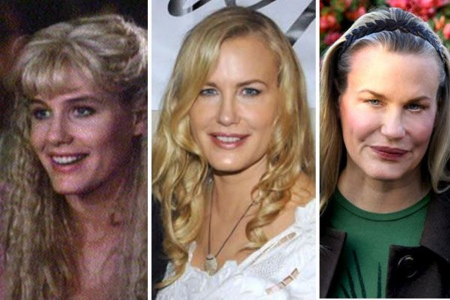 hírességek,sztárok,plasztika,botox