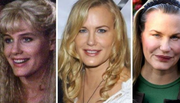 hírességek,sztárok,plasztika,botox