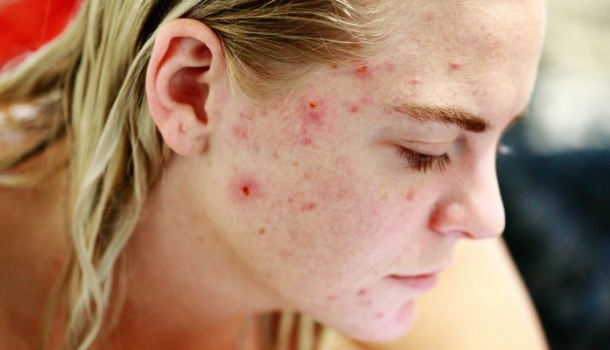 Borítókép: Öt tipp, hogy elkerüld a nyári pattanásokat