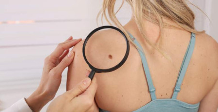 Borítókép: Eltűnt az anyajegyem, akkor most baj van?