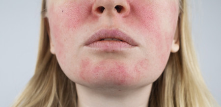 Borítókép: Így lehet sikeres a rosacea kezelése 8 lépésben: gyógyíthatatlan, de kordában tartható a szakértők tanácsait megfogadva