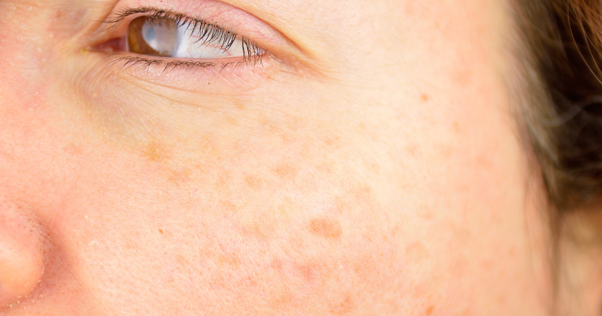 Borítókép: 7 bőrápolási hiba, ami csak ronthat a pigmentfoltokon