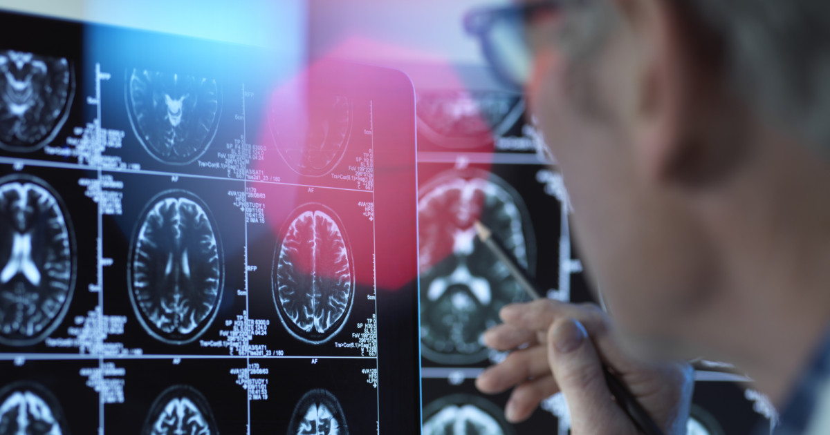 Áttörést érhettek el a demencia elleni küzdelemben