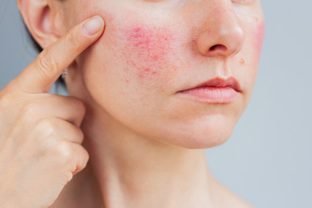 Borítókép: A rosacea kialakulásának okai és kezelése – Így szabadulhatsz meg a kellemetlen tünetektől! 